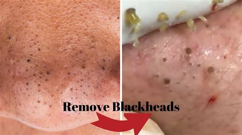 Blackheads removal youtube - removing blackheads, blackheads 2021 new, remove & extract cystic acne, milia removal, skin care videos relaxing and satisfymore video : https://www.youtube.... 